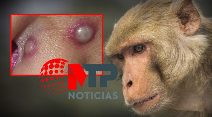 Viruela del mono: ¿por qué en Puebla se activó una alerta sanitaria?