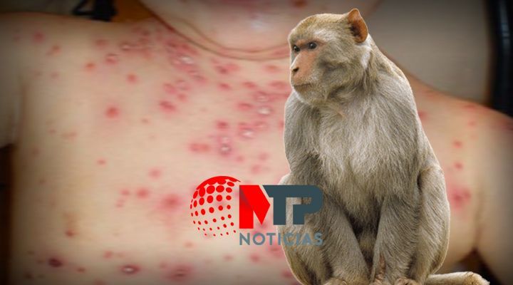 Viruela del mono: estos paises ya confirmaron casos, llegara a Mexico