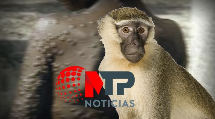 Viruela del mono: síntomas de la extraña enfermedad que preocupa al mundo