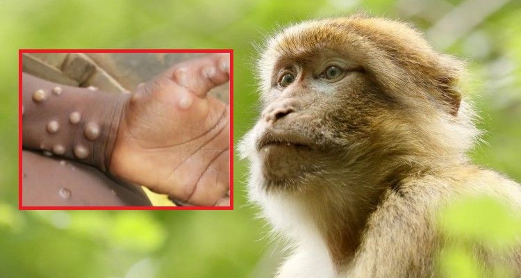 viruela del mono síntomas