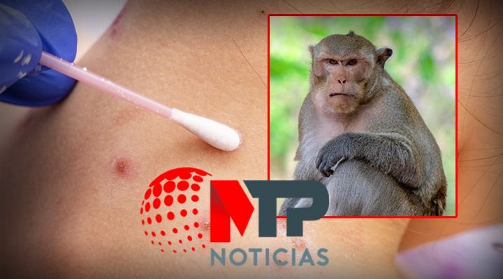 Actividad sexual: la principal causa de contagio de la viruela del mono
