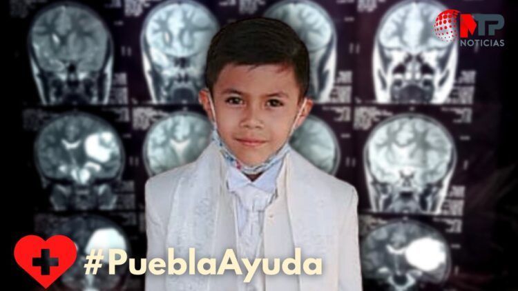 Puebla Ayuda Joshua necesita cirugía