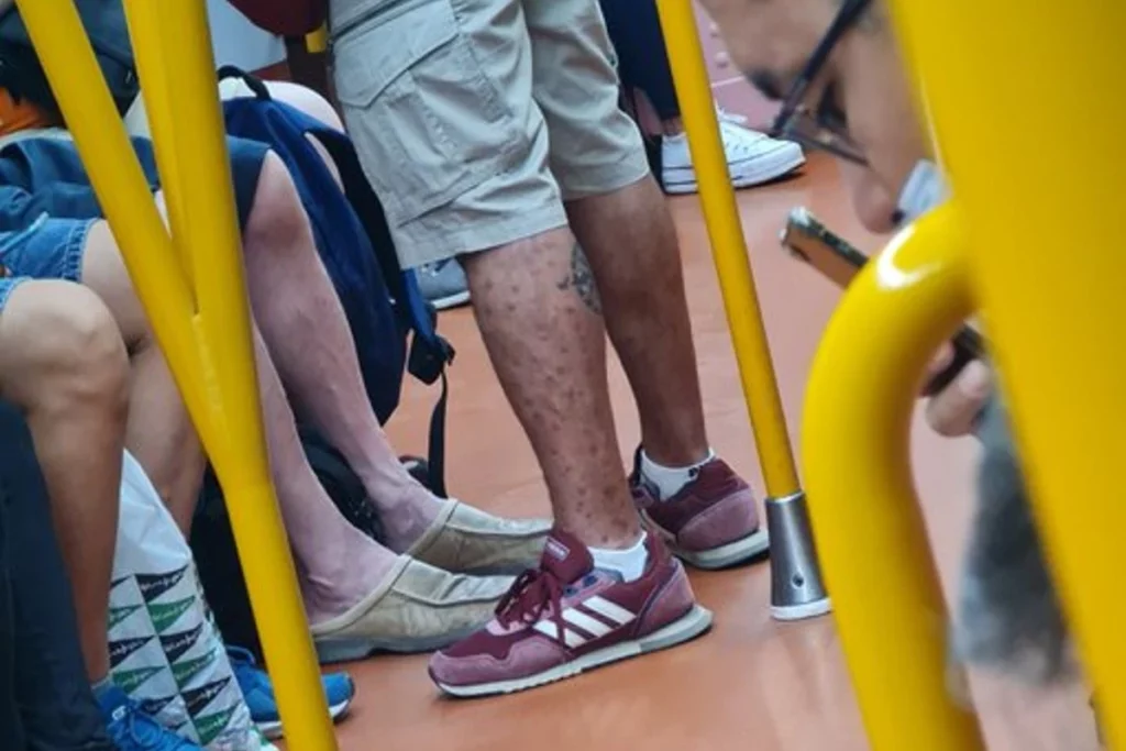 Indigna hombre enfermo de viruela del mono que viajo en metro