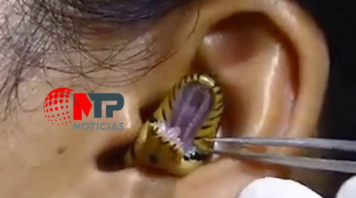 Medico extrae serpiente del oido de una mujer; video causa horror en internet