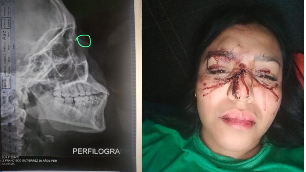 Activista Monserrat y radiografía de su nariz rota por su novio.