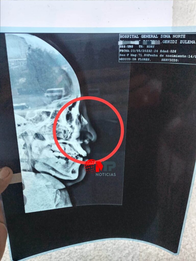 Radiografía que muestra la fractura de Gehidi