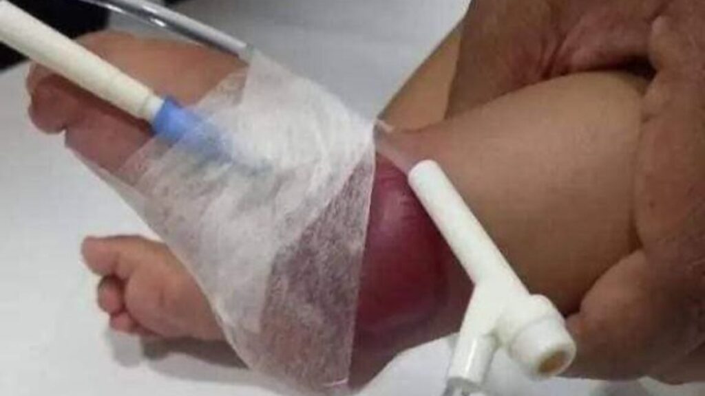 Lesionan a bebé de 3 meses en hospital de Coxcatlán, acusan negligencia médica